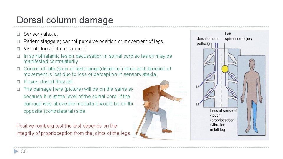 Dorsal column damage � � � � Sensory ataxia. Patient staggers; cannot perceive position