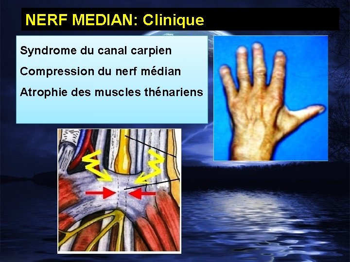 NERF MEDIAN: Clinique Syndrome du canal carpien Compression du nerf médian Atrophie des muscles