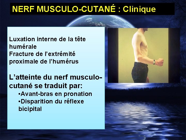 NERF MUSCULO-CUTANÉ : Clinique Luxation interne de la tête humérale Fracture de l’extrémité proximale