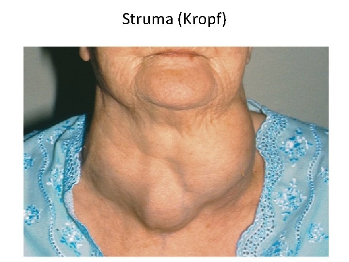 Struma (Kropf) 