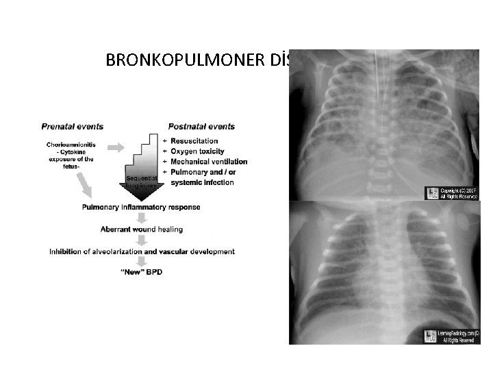 BRONKOPULMONER DİSPLAZİ 