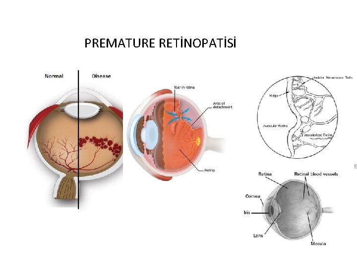 PREMATURE RETİNOPATİSİ 