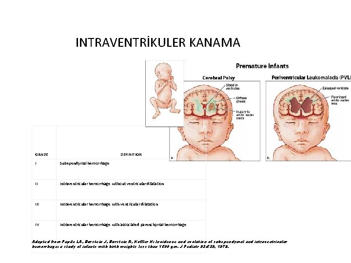 INTRAVENTRİKULER KANAMA GRADE DEFINITION I Subependymal hemorrhage II Intraventricular hemorrhage without ventricular dilatation III