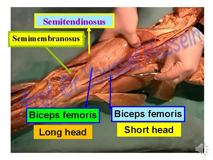 Semitendinosus Semimembranosus Biceps femoris Long head Short head 