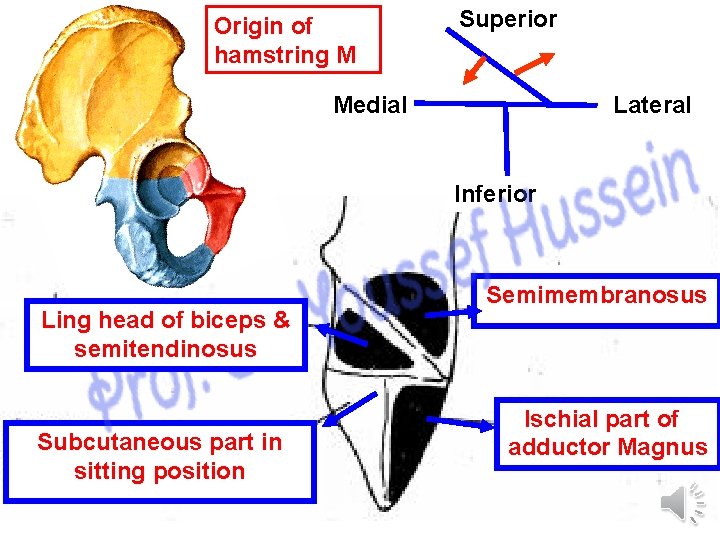 Origin of hamstring M Superior Lateral Medial Inferior Ling head of biceps & semitendinosus