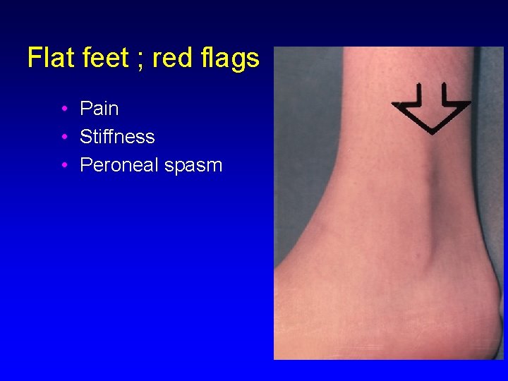 Flat feet ; red flags • Pain • Stiffness • Peroneal spasm 