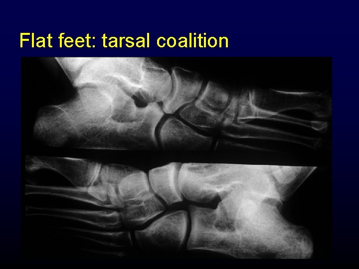 Flat feet: tarsal coalition 