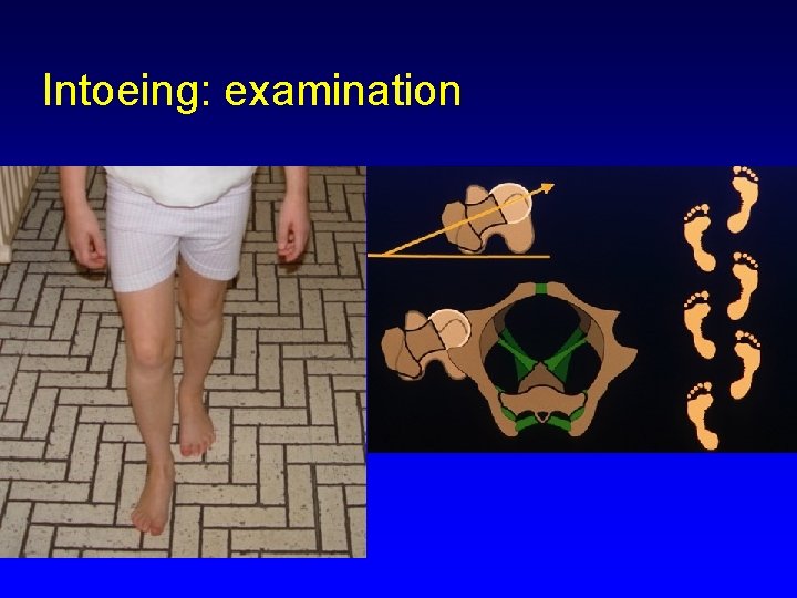 Intoeing: examination 
