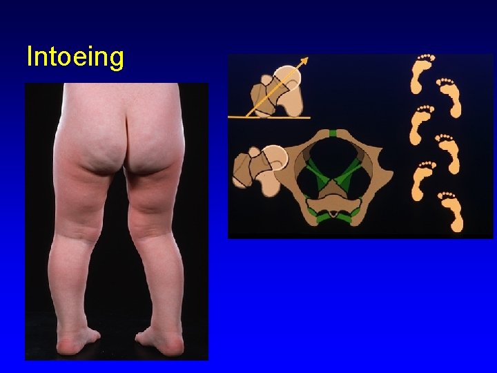 Intoeing 