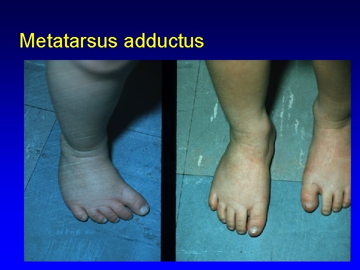 Metatarsus adductus 