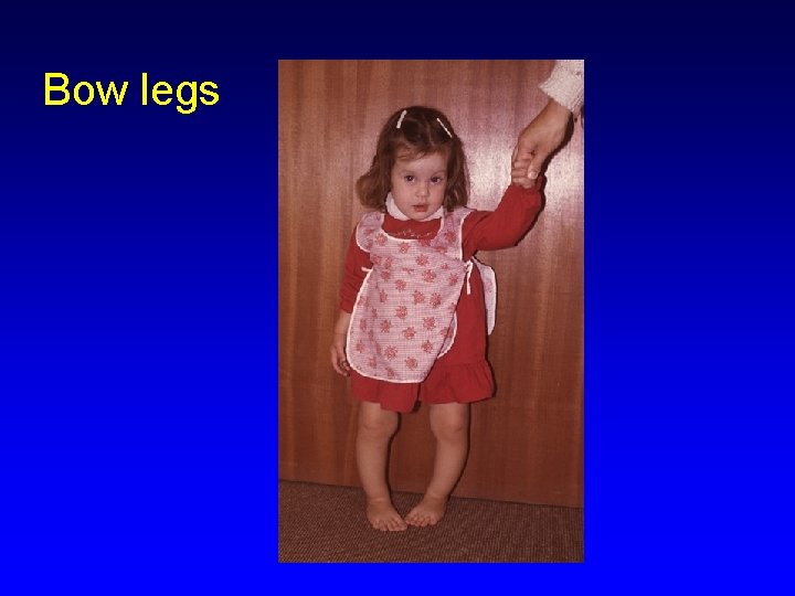 Bow legs 
