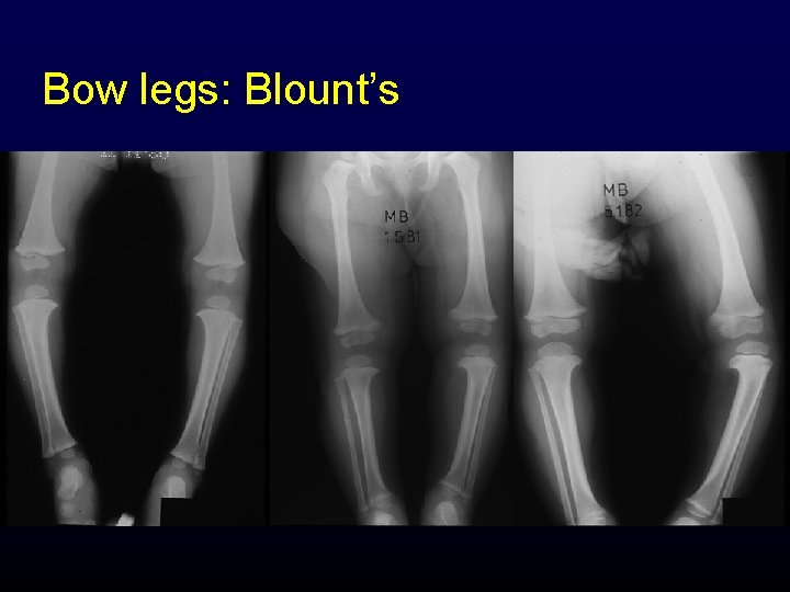 Bow legs: Blount’s 