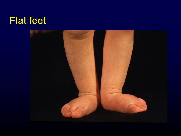 Flat feet 