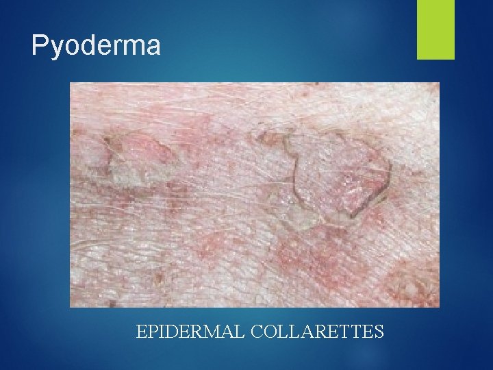 Pyoderma EPIDERMAL COLLARETTES 