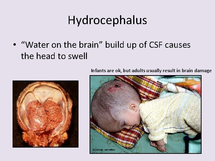 Hydrocephalus • “Water on the brain” build up of CSF causes the head to