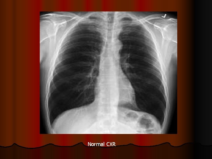 Normal CXR 