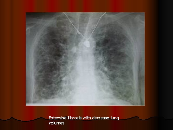 Extensive fibrosis with decrease lung volumes 