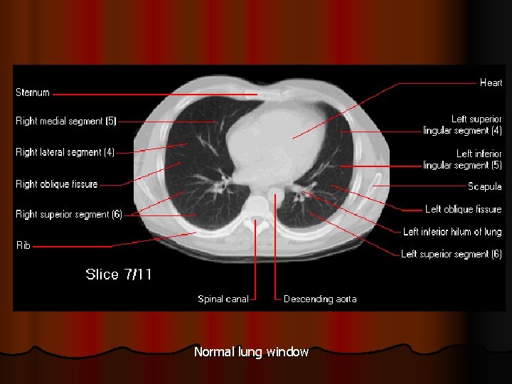 Normal lung window 