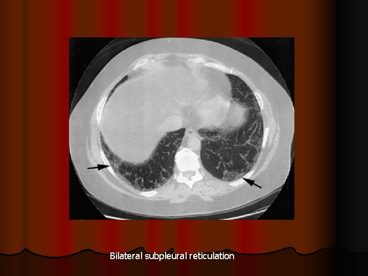 Bilateral subpleural reticulation 