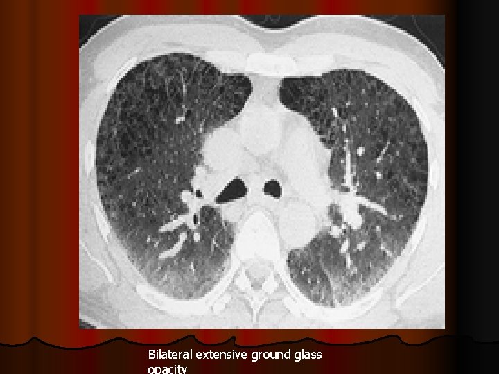 Bilateral extensive ground glass opacity 