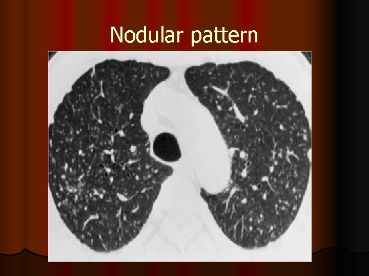Nodular pattern 