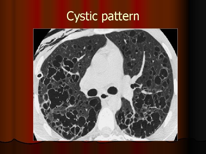 Cystic pattern 