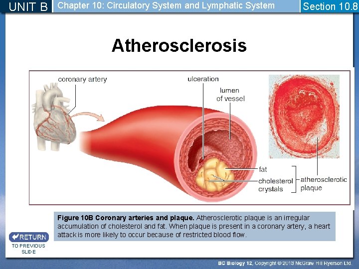 UNIT B Chapter 10: Circulatory System and Lymphatic System Section 10. 8 Atherosclerosis Figure