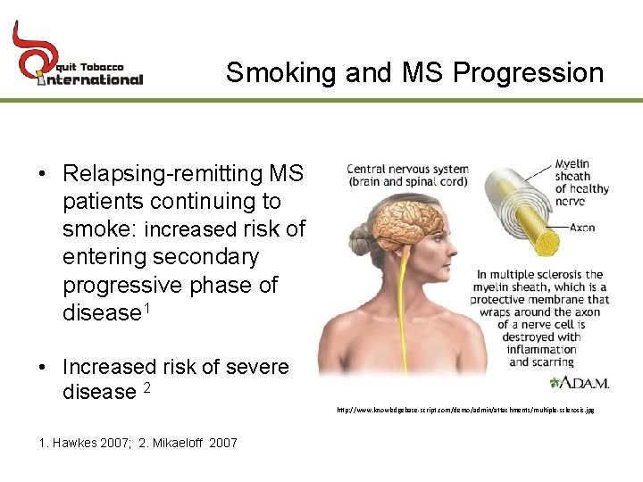 Smoking and MS Progression • Relapsing-remitting MS patients continuing to smoke: increased risk of