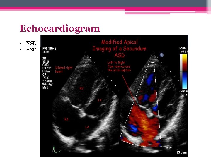 Echocardiogram • VSD • ASD 