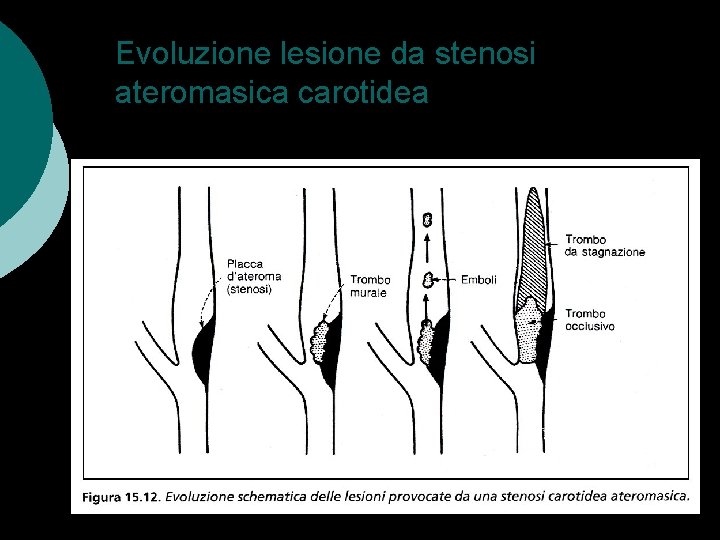Evoluzione lesione da stenosi ateromasica carotidea AIT ICTUS 