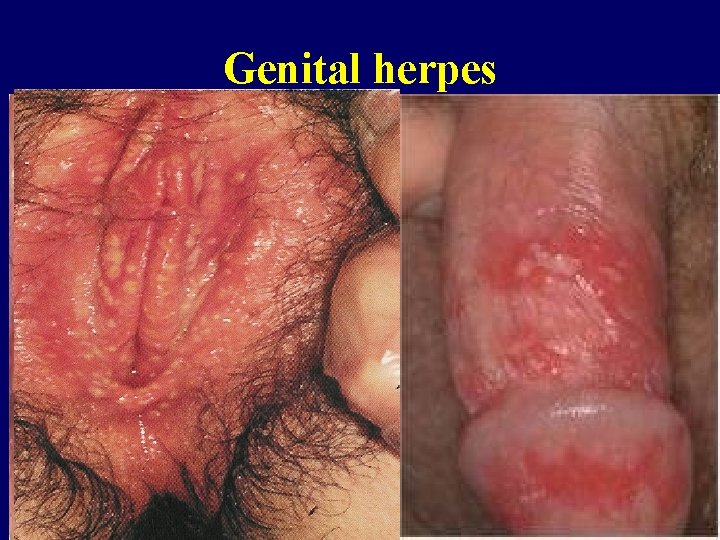 Genital herpes 