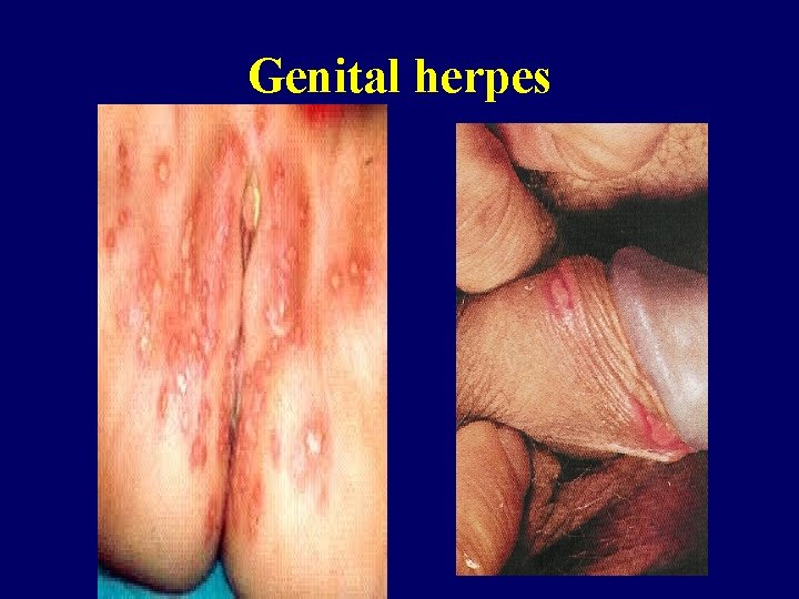 Genital herpes 