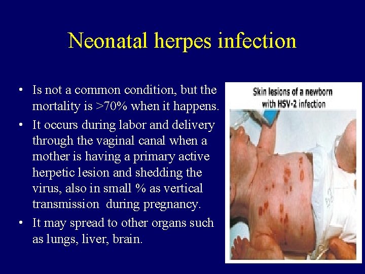 Neonatal herpes infection • Is not a common condition, but the mortality is >70%