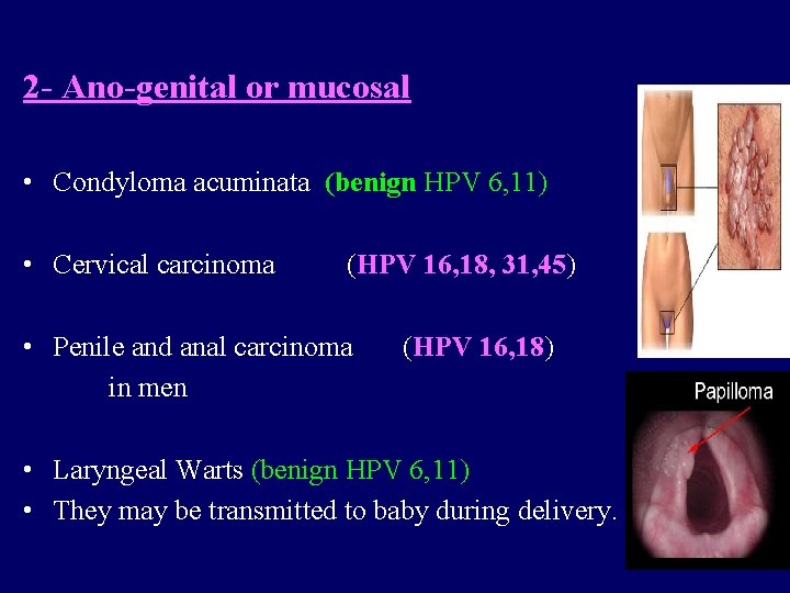 2 - Ano-genital or mucosal • Condyloma acuminata (benign HPV 6, 11) • Cervical