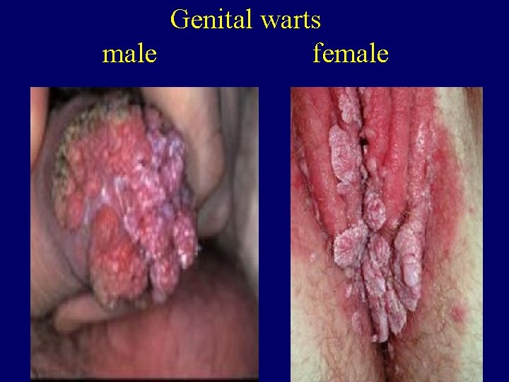 Genital warts male female 