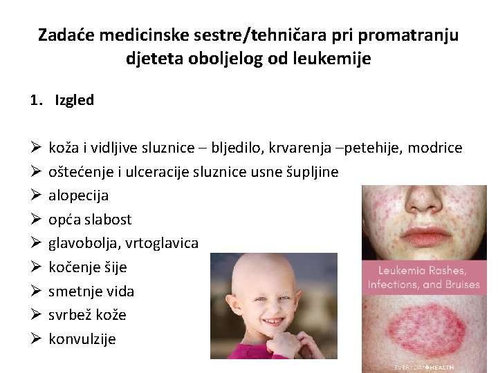 Zadaće medicinske sestre/tehničara pri promatranju djeteta oboljelog od leukemije 1. Izgled Ø Ø Ø