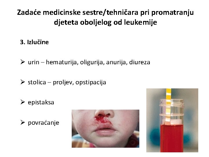 Zadaće medicinske sestre/tehničara pri promatranju djeteta oboljelog od leukemije 3. Izlučine Ø urin –