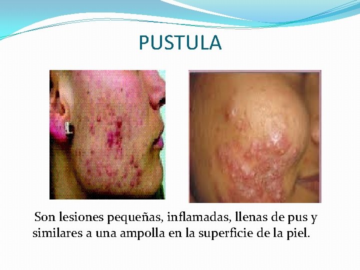 PUSTULA Son lesiones pequeñas, inflamadas, llenas de pus y similares a una ampolla en