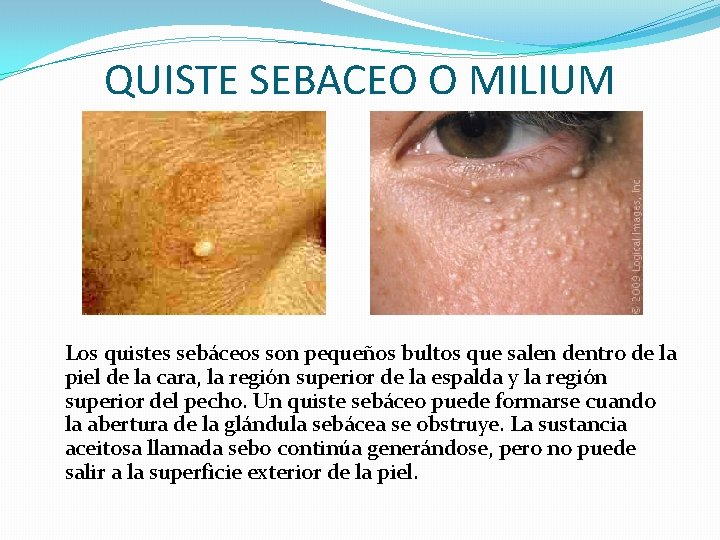 QUISTE SEBACEO O MILIUM Los quistes sebáceos son pequeños bultos que salen dentro de