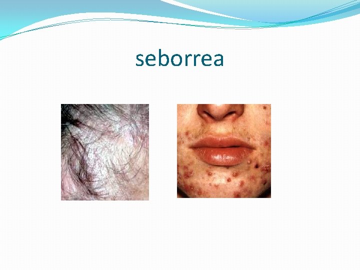 seborrea 