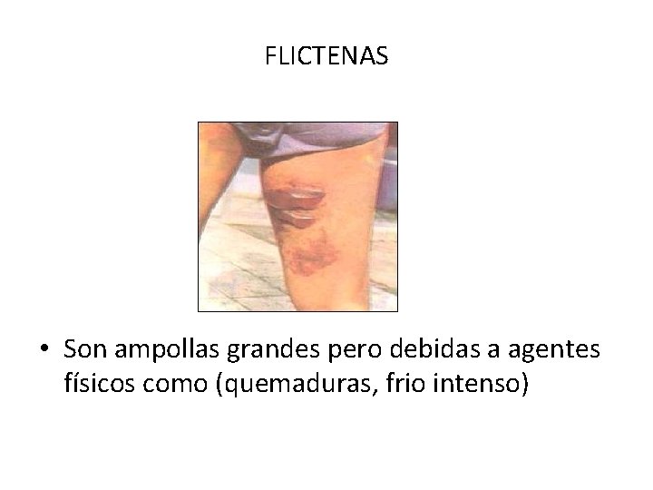 FLICTENAS • Son ampollas grandes pero debidas a agentes físicos como (quemaduras, frio intenso)