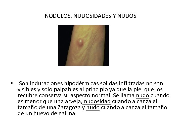 NODULOS, NUDOSIDADES Y NUDOS • Son induraciones hipodérmicas solidas infiltradas no son visibles y