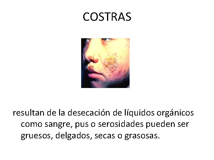 COSTRAS resultan de la desecación de líquidos orgánicos como sangre, pus o serosidades pueden