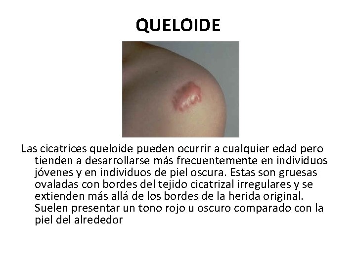 QUELOIDE Las cicatrices queloide pueden ocurrir a cualquier edad pero tienden a desarrollarse más