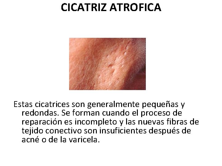 CICATRIZ ATROFICA Estas cicatrices son generalmente pequeñas y redondas. Se forman cuando el proceso