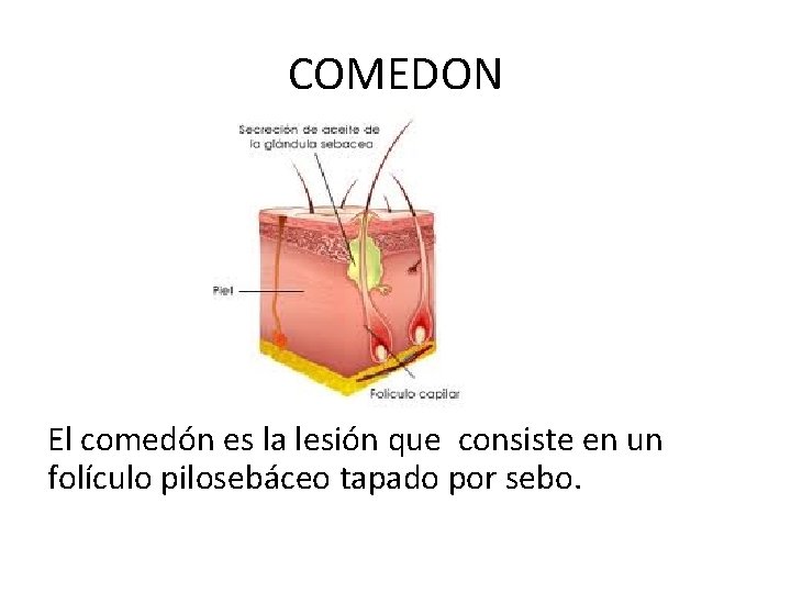 COMEDON El comedón es la lesión que consiste en un folículo pilosebáceo tapado por