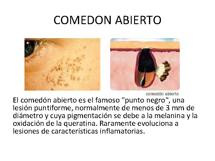 COMEDON ABIERTO El comedón abierto es el famoso "punto negro", una lesión puntiforme, normalmente