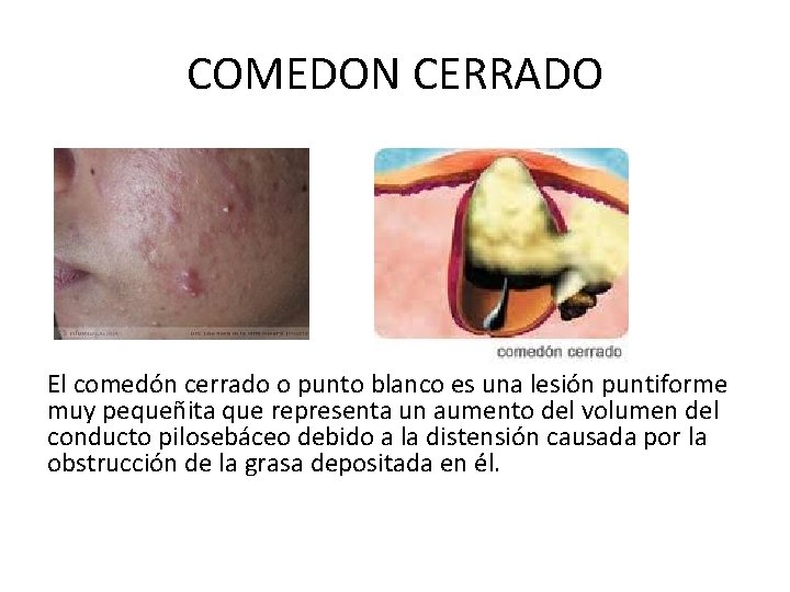 COMEDON CERRADO El comedón cerrado o punto blanco es una lesión puntiforme muy pequeñita