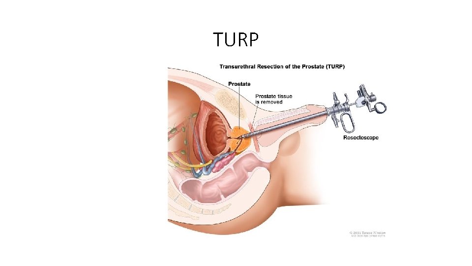 TURP 