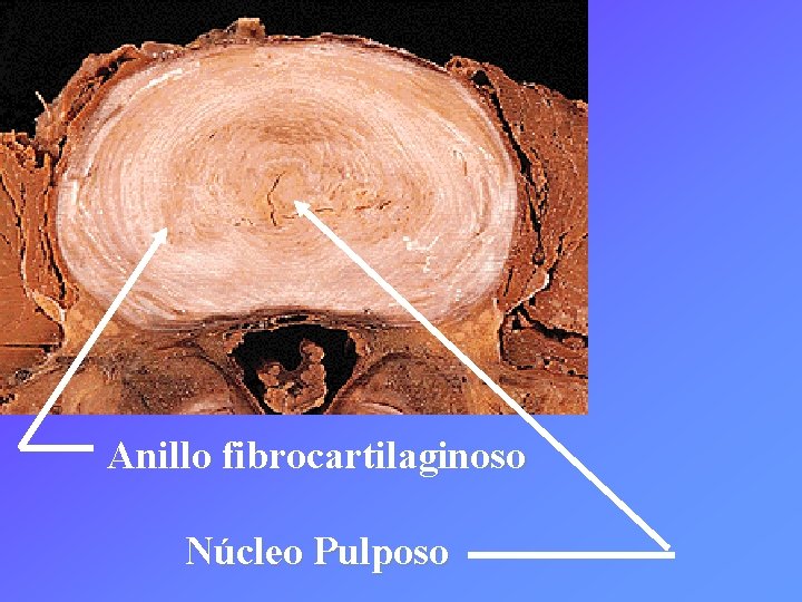 Anillo fibrocartilaginoso Núcleo Pulposo 